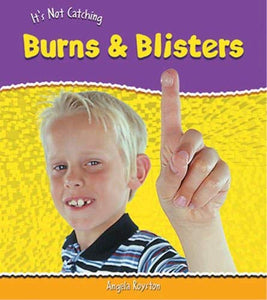 It's Not Catching: Burns And Blisters 