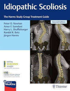 Idiopathic Scoliosis 