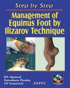 Step by Step: Management of Equinus Foot by Ilizarov Technique 